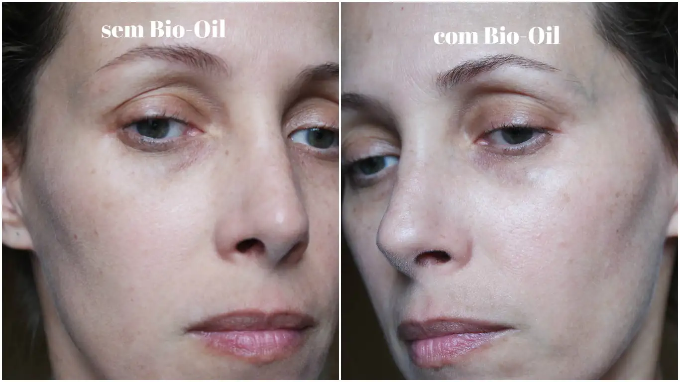 5 razões para usar Bio-Oil: o favorito de Kim Kardashian! 4 bio-oil antes e depois no rosto kutiz blog da ana